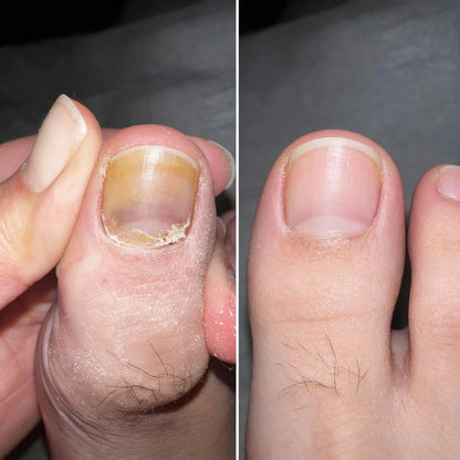 Fungal Nail Renewal Patches